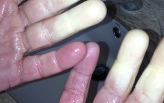 Fenómeno de Raynaud