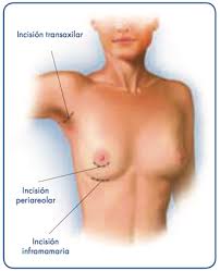 Mamoplastia y Buceo