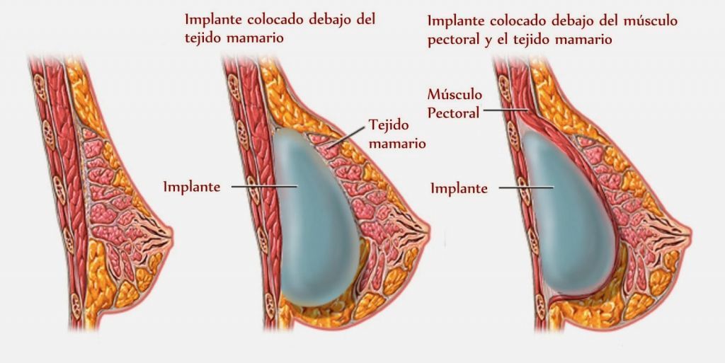 Mamoplastia y Buceo